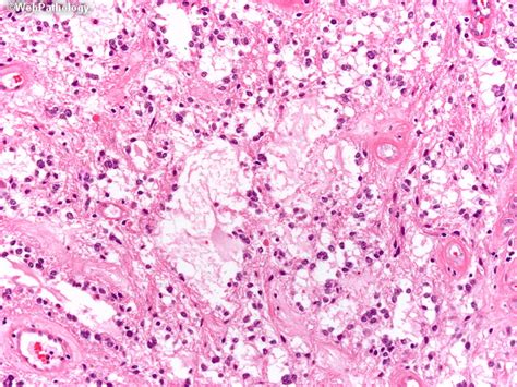 Webpathology.com: A Collection of Surgical Pathology Images