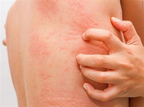 10 causes of red spots on skin that itch- Health2Wellness Blog