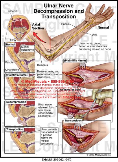 Ulnar Nerve Decompression and Transposition Medical Illustration