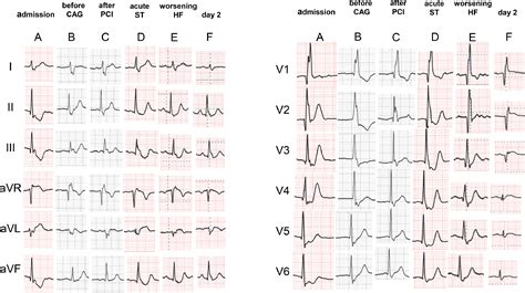 The reappearance of de Winter's pattern caused by acute stent ...