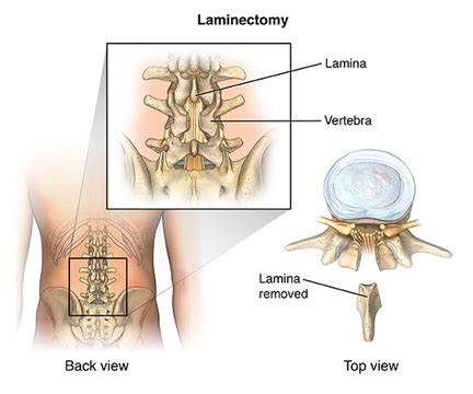 Laminectomy | Procedure, Preparation and Recovery | Neuroaxis