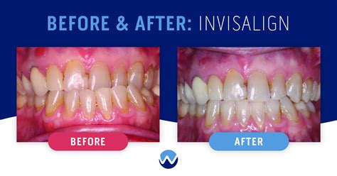 Clear Aligners Before & After: See How They Transform Smiles • Woodhill ...