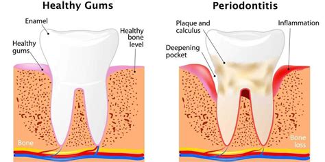 What Is Aggressive Periodontal Disease at Arlene Almanzar blog