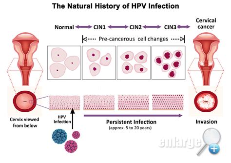 Hpv Cervical Cancer Treatment