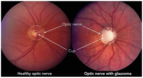 Glaucoma Diagnosis