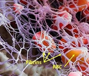 Fibrinous exudate - Definition and Examples - Biology Online Dictionary