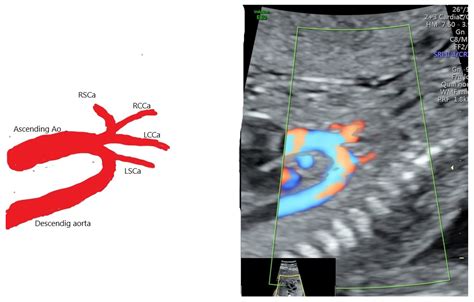 Diagnostics | Free Full-Text | Prenatal Diagnosis of Bovine Aortic Arch Anatomic Variant