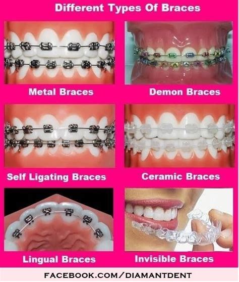 The 25+ best Different types of braces ideas on Pinterest | Different types of yoga, Yoga types ...