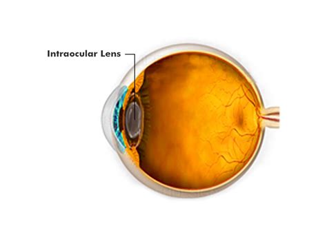 Monofocal Vs Multifocal | Cataract/ Motiyabind Surgery Lens