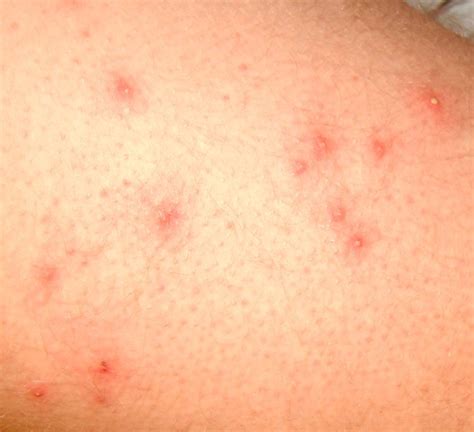 Folliculitis – Pictures, Symptoms, Causes, Treatment | hubpages