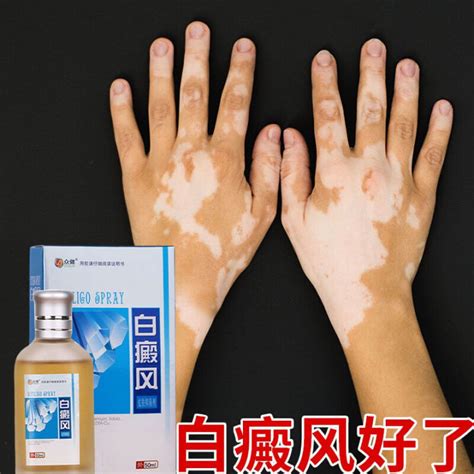 [Vitiligo] Refuse to Be a Special Killer for Zebra White Spot | Lazada