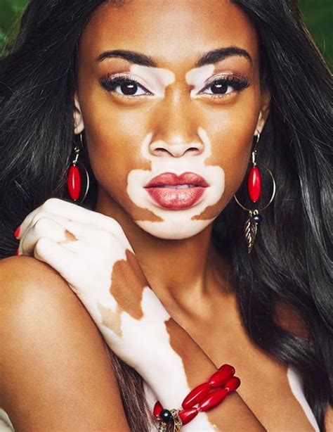 19 Times This Model With A Skin Condition Gave Us Life | Vitiligo model, Vitiligo treatment ...