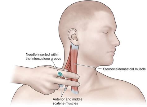 Supraclavicular and Infraclavicular Nerve Blocks | Anesthesia Key