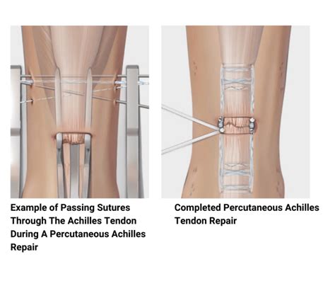 Achilles Tendon Ruptures | Dr. Edward S. Chang, MD