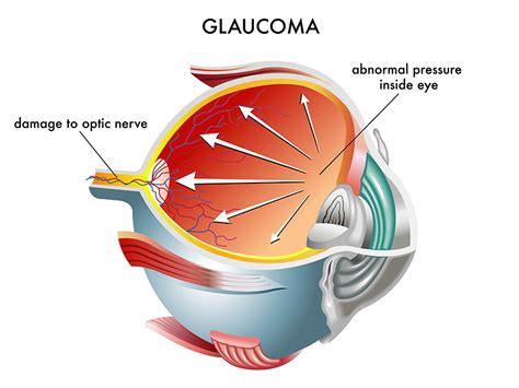 Glaucoma | Visual Eyes Comprehensive Eye Care