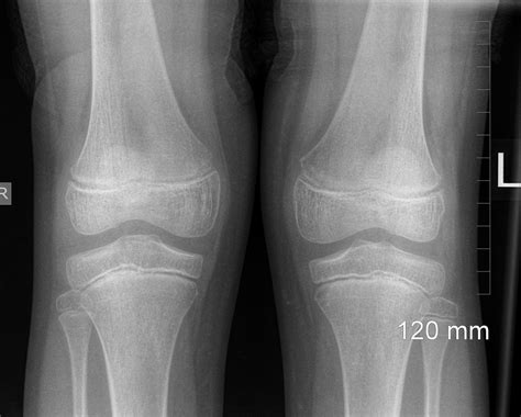 [DIAGRAM] Diagram Of Normal Knee - MYDIAGRAM.ONLINE