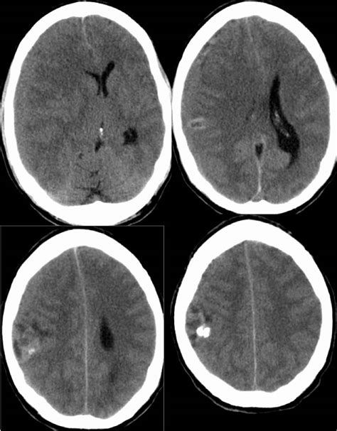 Gliosarcoma