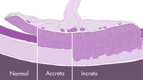 Placenta Accreta Spectrum - What to Expect - YouTube