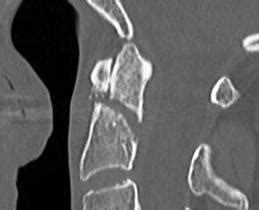 Dens / Odontoid Fracture | The Bone School