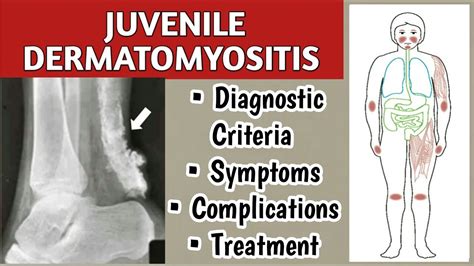 Juvenile Dermatomyositis Symptoms, Diagnostic Criteria, Complications, and Treatment - YouTube