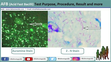 CSF For AFB Test Purpose, Procedure, Result and more | Lab Tests Guide