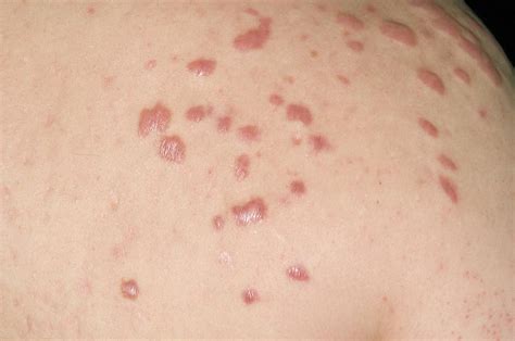 Keloid Scars In Acne Vulgaris Photograph by Dr P. Marazzi/science Photo ...