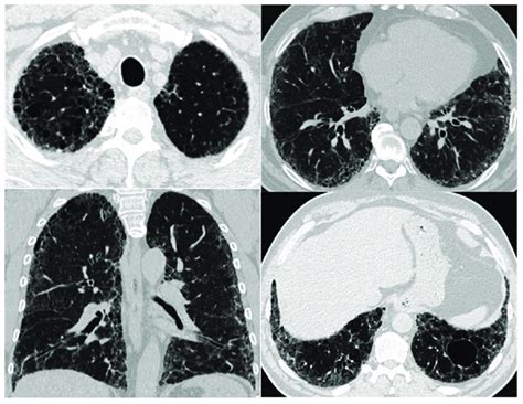 HRCT patterns in CPFE. A predominant pattern of centrilobular emphysema ...