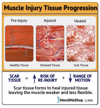 Muscle Strain Injury