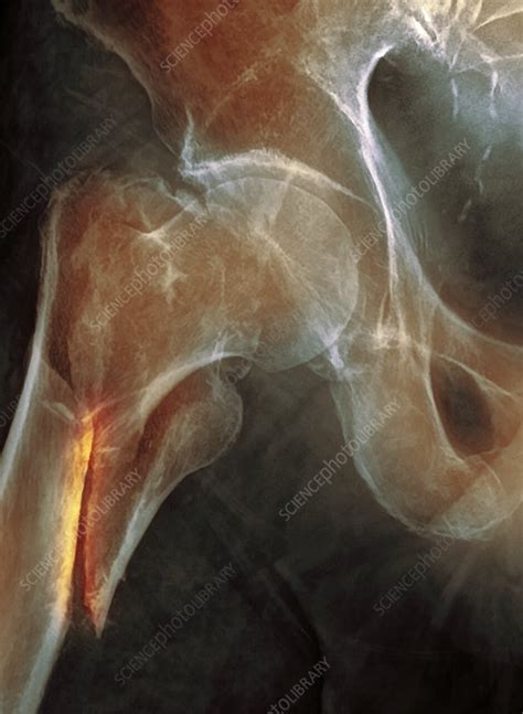 Broken hip, X-ray - Stock Image - C050/9712 - Science Photo Library