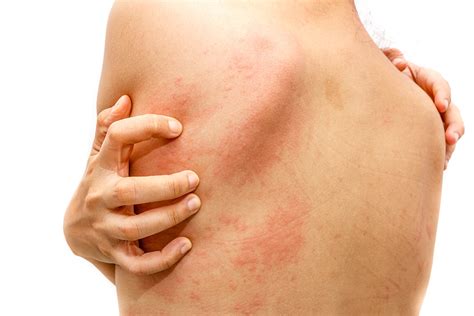 Get Rid of Skin Hives: When Do You Need to Visit a Dermatologist in ...