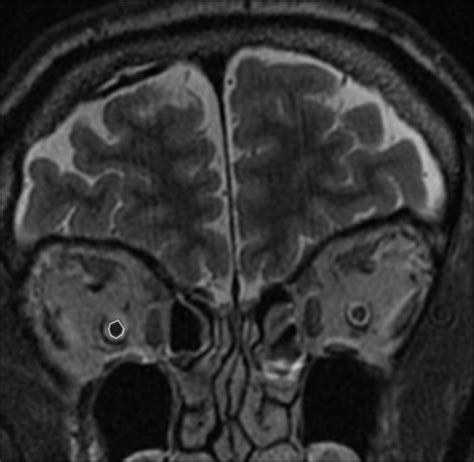 Diagnostic Utility of Optic Nerve Measurements with MRI in Patients ...