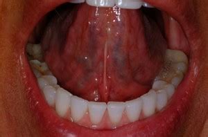 Cold Sore Under Tongue | via Anatomy Pictures Gallery ift.tt… | Flickr