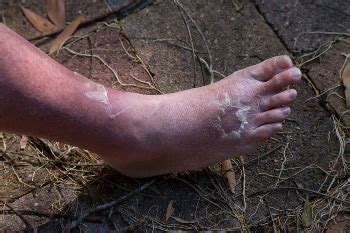 What is Cellulitis | Podiatrist Surprise Arizona | Fixing Feet PLLC