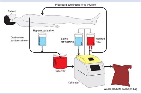 Figure 1 from Cell salvage as part of a blood conservation strategy in ...