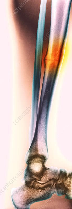 Healed leg break, X-ray - Stock Image - M330/1103 - Science Photo Library