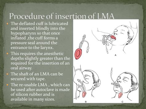 PPT - LARYNGEAL MASK AIRWAY (LMA) PowerPoint Presentation, free ...