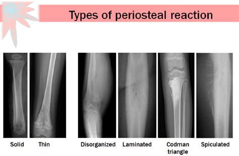 Figure 3 from Malignant causes of periosteal reaction in paediatrics: part 2 | Semantic Scholar