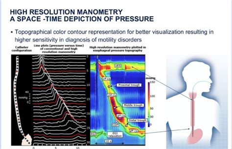 Understanding Esophageal Manometry: Insights, Functioning