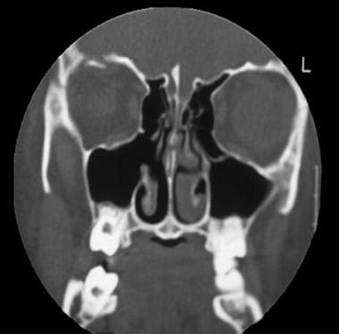 Orbital Fractures: Practice Essentials, Problem, Epidemiology