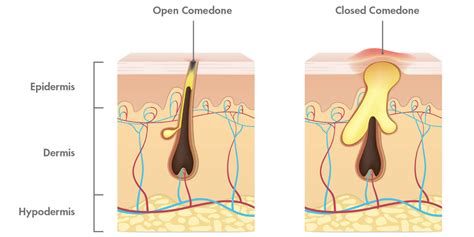 Open, Closed, WTH Are Comedones? | Hero Cosmetics