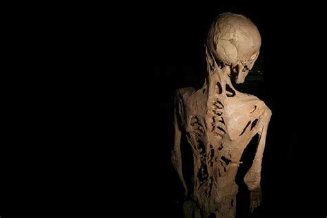 Horrible Rare Genetic Disease Turns Humans to Statues