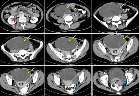 Ovarian endometrioid adenocarcinoma and mucinous cystadenoma ...