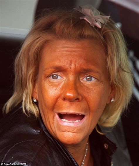 Tan Mom Patricia Krentcil has discovered Botox and says her pale look ...