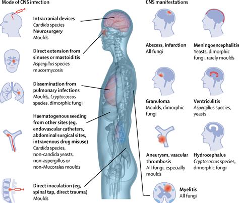 Advances in the diagnosis and treatment of fungal infections of the CNS - The Lancet Neurology