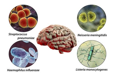 Étiologie De La Méningite Bactérienne Illustration Stock - Illustration ...