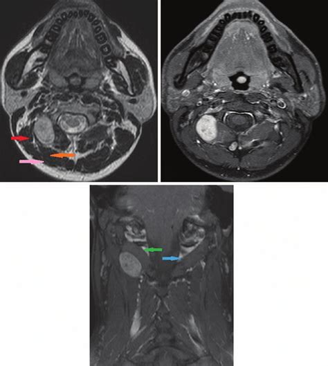 (a) T2-weighted axial images showing a T2-hyperintense lesion deep to... | Download Scientific ...