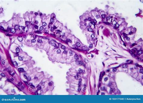 Prostate Cancer, Light Micrograph Stock Photo - Image of microscopic, hematoxylin: 183177340