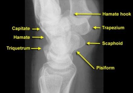 Hook of Hamate Fracture - Hand - Orthobullets