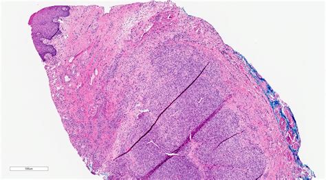 Mucocele Histology