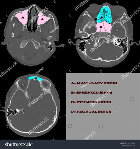 Anatomy Paranasal Sinuses Ct Scan Vector: immagine vettoriale stock ...